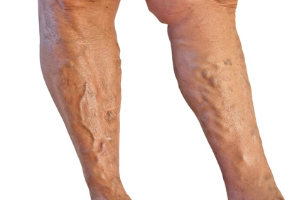 Varicose Veins: Causes, Treatments, and Prevention